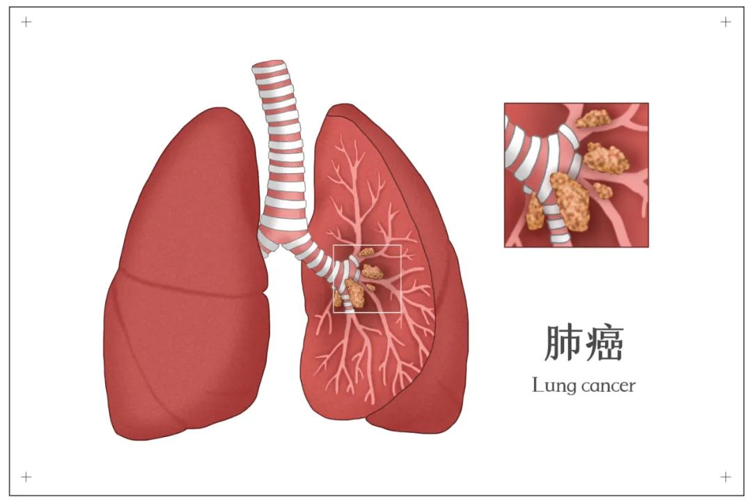 肿瘤和癌症是一回事吗
